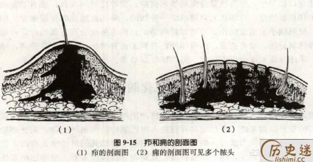 为什么古人只要背上长疮就会死呢