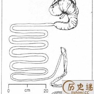 古代人得了阑尾炎会怎么办？
