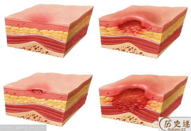 为什么古人只要背上长疮就会死呢